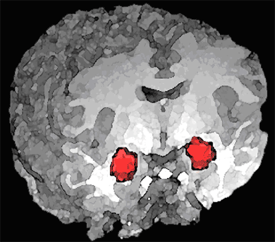 amygdala1